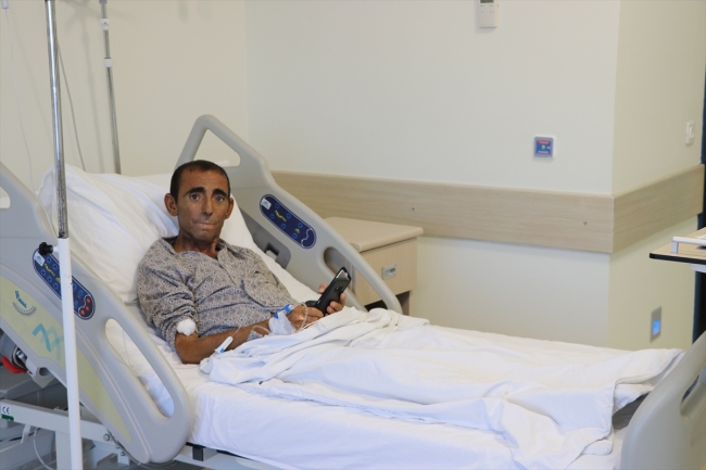 Vücudunda beş böbrekle yaşıyor